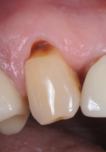 cervical abrasion- gutter-like depression on the neck of a tooth 