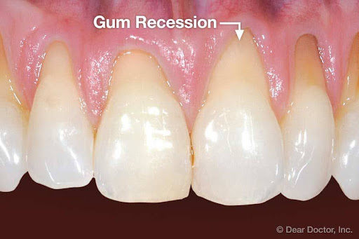 gingival recession - what wearing away of the gum looks like