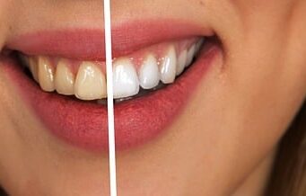 7 Easy Ways to Get Rid of Extrinsic Teeth Stains Extrinsic teeth stains