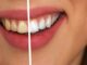 7 Easy Ways to Get Rid of Extrinsic Teeth Stains Extrinsic teeth stains