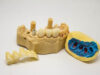 Common Types of Cracked Tooth, Causes, Symptoms and Treatment Cracked tooth treatment