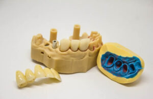 Common Types of Cracked Tooth, Causes, Symptoms and Treatment Cracked tooth treatment