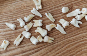 Tooth Decay: Causes, Treatment and Prevention Tooth decay treatment