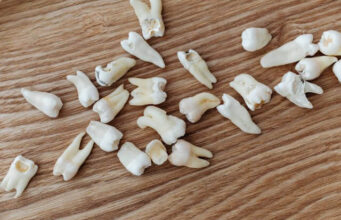 Tooth Decay: Causes, Treatment and Prevention Tooth decay treatment