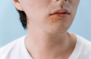 7 Common Oral Infections, Their causes and Treatment Oral infections treatment