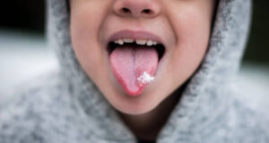 Safe and Effective Treatment for Oral Thrush Oral thrush treatment