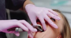 3rd Molar Extraction: Everything You Need to Know About It 3rd molar extraction