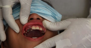 Common Causes of Cavities in Milk Teeth Milk teeth cavities