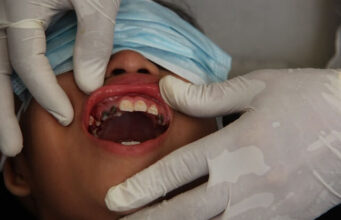 Common Causes of Cavities in Milk Teeth Milk teeth cavities