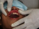 Common Causes of Cavities in Milk Teeth Milk teeth cavities